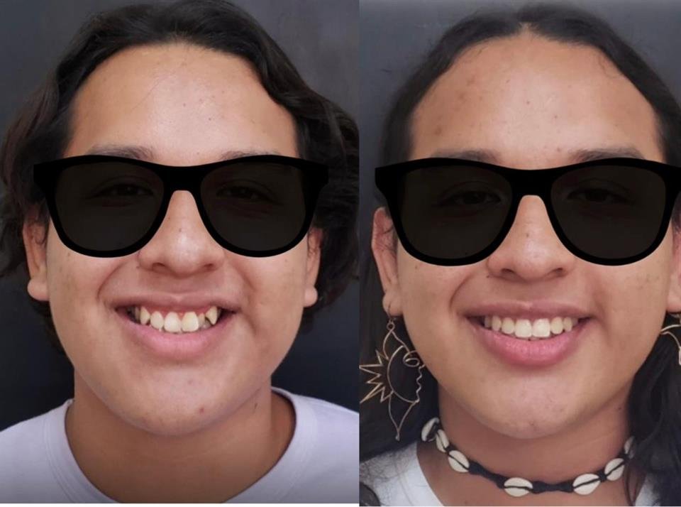 Antes y después — caso 2