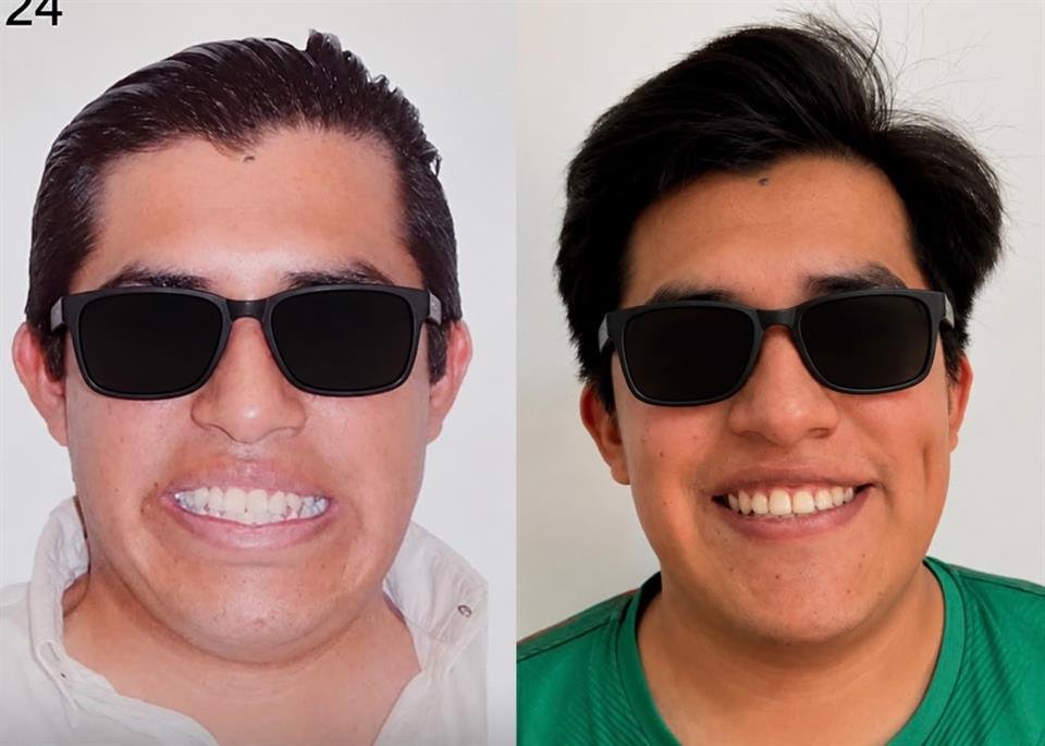 Antes y después — caso 3